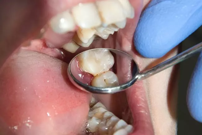 Artikel ini akan membahas cara merontokan karang gigi terbaik. Cara-cara ini akan menjelaskan bagaimana menggunakan berbagai alat untuk menghilangkan karang gigi, serta bagaimana menggunakan beberapa produk untuk mengurangi kerusakan gigi.
