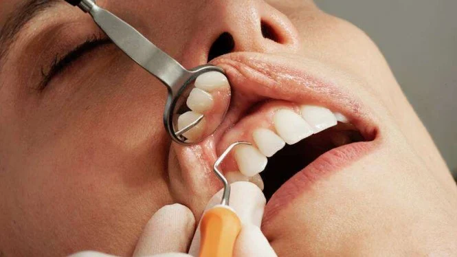 Artikel ini akan membahas cara merontokan karang gigi terbaik. Cara-cara ini akan menjelaskan bagaimana menggunakan berbagai alat untuk menghilangkan karang gigi, serta bagaimana menggunakan beberapa produk untuk mengurangi kerusakan gigi.