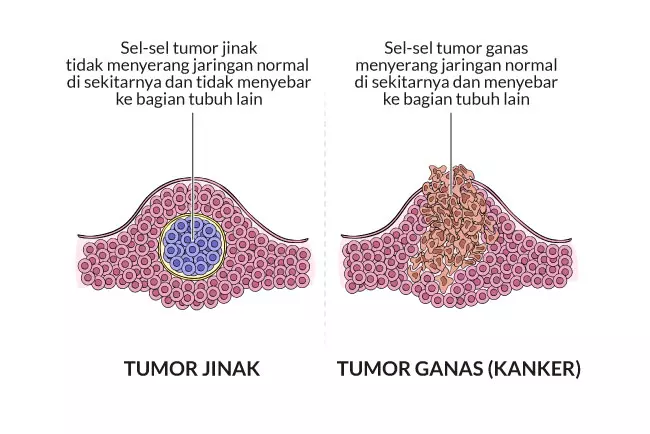 gejala tumor payudara